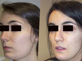 feminización del mentón y simetrización facial