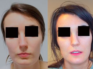 Asimetría facial y feminización mandibular