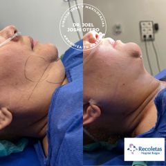 Liposucción y platismopexia cervical - Dr. Joshi Otero