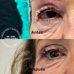 Blefaroplastia - Dr. Joshi Otero