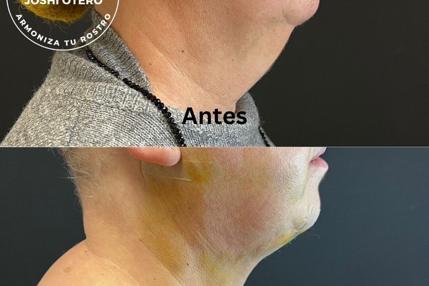 Lipofilling antes y después - 844550