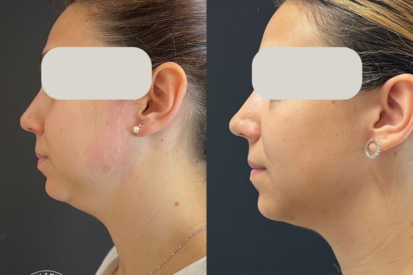 Lipofilling antes y después - 844552
