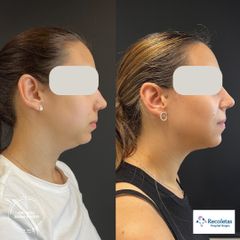 Lipofilling - Dr. Joshi Otero