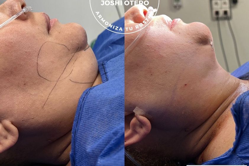 Lipofilling antes y después - 844557