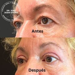 Blefaroplastia - Dr. Joshi Otero