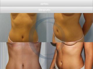 Antes y después LIPOSUCCION