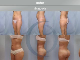 Antes y después BBL
