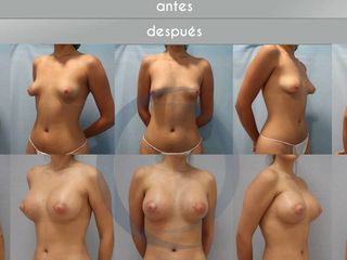 Antes y después MAMAS TUBEROSAS