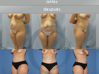 Antes y después Abdominoplastia