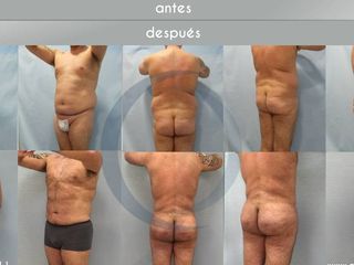 Antes y después - BBL  MASCULINO
