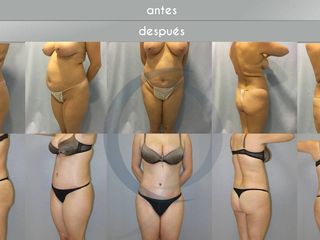Antes y después Abdominoplastia
