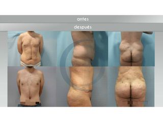 Antes y después lipoescultura 