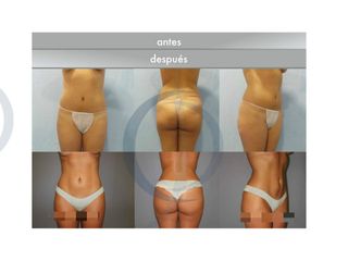 Antes y después lipoescultura 