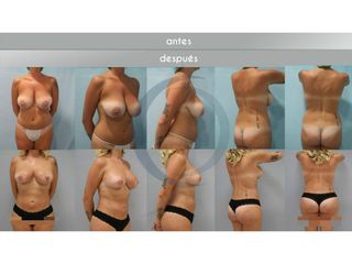 Antes y después - mastopexia liposucción
