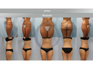 Antes y después Liposucción