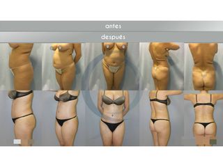 Antes y después abdominoplastia 