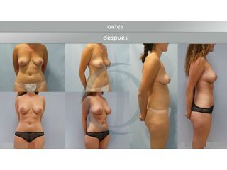 Antes y después Aumento de pecho - lipo