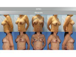 Antes y despuñes mastopexia secundaria 