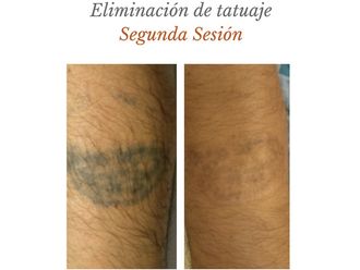 Eliminación de tatuajes - 632344