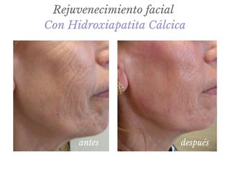 Rellenos faciales - 632346