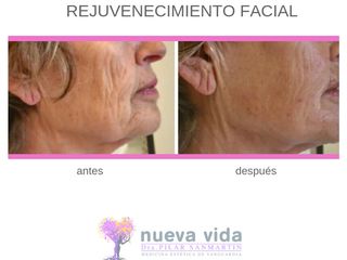 Antes y después Rejuvenecimiento Facial