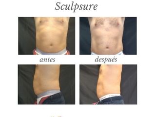 Antes y después : SCULPSURE