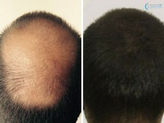 Antes y despues. Alopecia avanzada en parte posterior