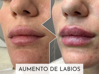 Clinicas Esquivel Valencia - Aumento de labios