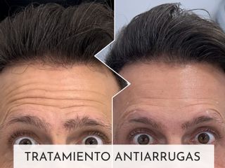 Clinicas Esquivel Valencia - Antiarrugas