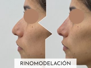 Clinicas Esquivel Valencia - Rinomodelación
