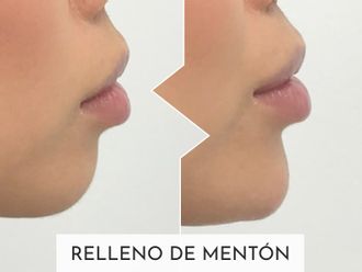 Marcación mandibular antes y después - 877385