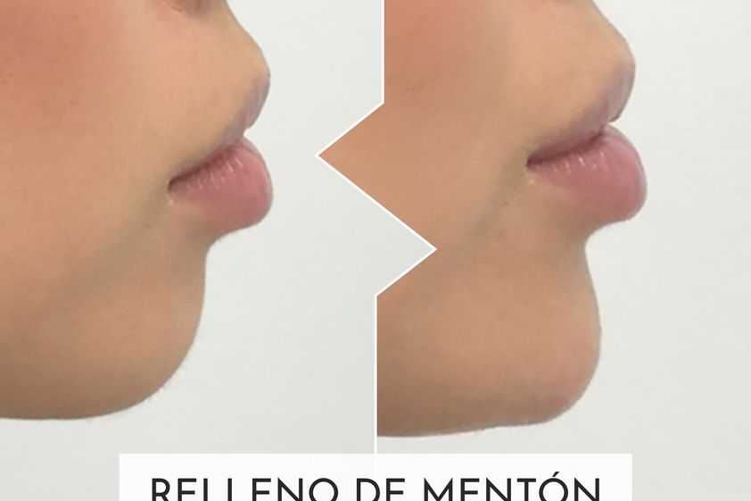 Marcación mandibular antes y después - 877385
