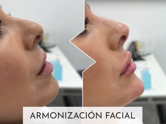 Aumento labios antes y después - 877386