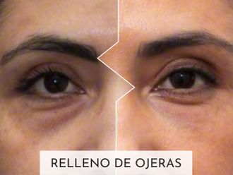 Eliminación ojeras antes y después - 877387