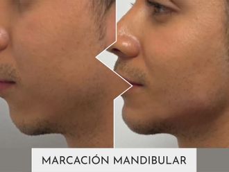 Marcación mandibular antes y después - 877388