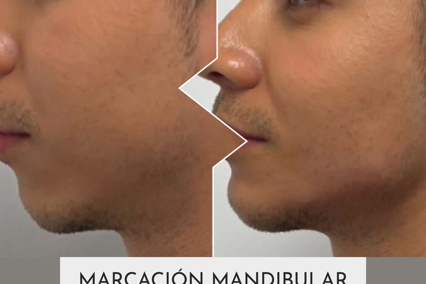 Marcación mandibular antes y después - 877388