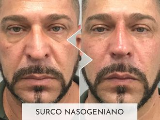 Eliminación arrugas antes y después - 877389