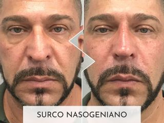 Clinicas Esquivel Valencia - Eliminación de arrugas