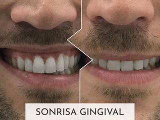 Clinicas Esquivel Valencia - Sonrisa Gingival