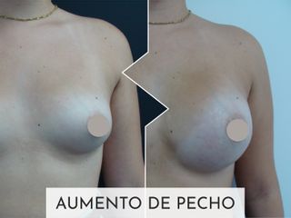 Clinicas Esquivel Valencia - Aumento de pecho