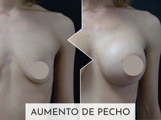 Clinicas Esquivel Valencia - Aumento de pecho