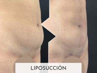 Clinicas Esquivel Valencia - Liposucción