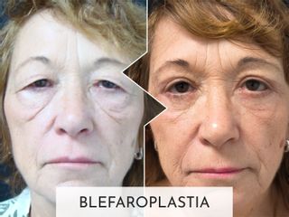 Clinicas Esquivel Valencia - Blefaroplastia
