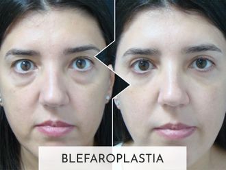 Blefaroplastia antes y después - 877396