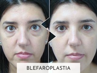 Clinicas Esquivel Valencia - Blefaroplastia