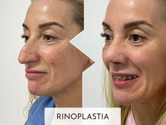 Rinoplastia antes y después - 877397