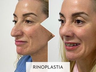 Clinicas Esquivel Valencia - Rinoplastia