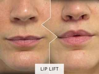 Clinicas Esquivel Valencia - Lip Lift