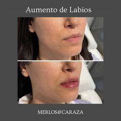Merlos & Caraza - Aumento de labios