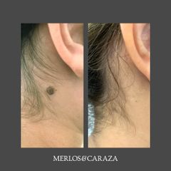 Verrugas - Merlos & Caraza